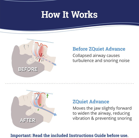 ZQuiet Advance Custom Anti-Snoring Mouthpiece