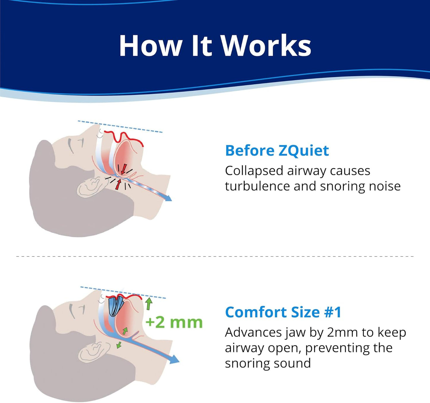 ZQuiet Anti-Snoring Mouthpiece - Comfort Size #1