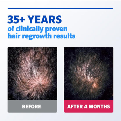 Rogaine Extra Strength 5% Minoxidil Topical Solution for Hair Loss & Regrowth