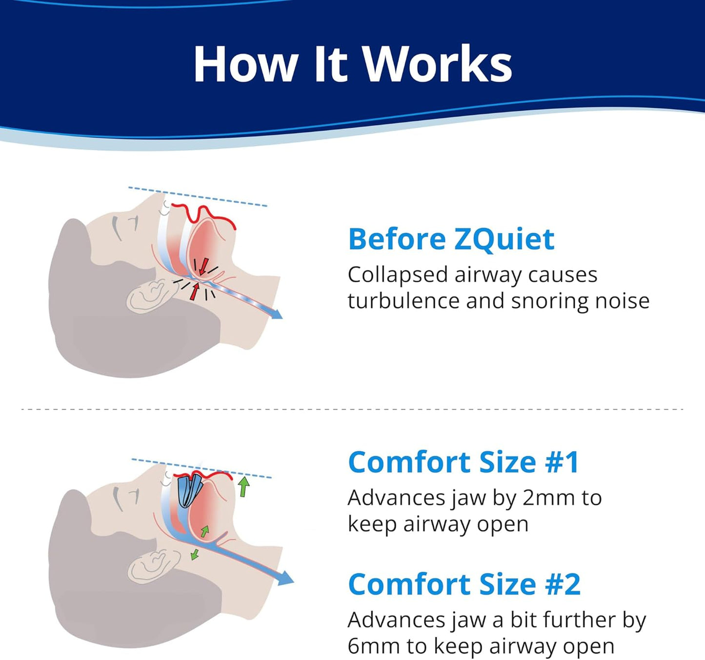 ZQuiet Anti-Snoring Mouthpiece - Starter Pack with 2 Sizes