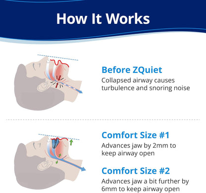 ZQuiet Anti-Snoring Mouthpiece - Starter Pack with 2 Sizes