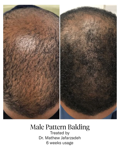 Calecim Advanced Hair System