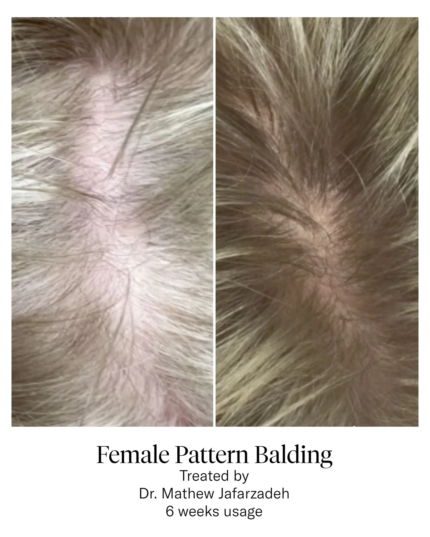 Calecim Advanced Hair System